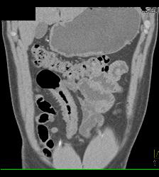 Active Crohn's Disease - CTisus CT Scan