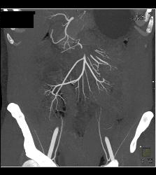 Active Crohn's Disease - CTisus CT Scan