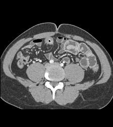 Active Crohn's Disease - CTisus CT Scan