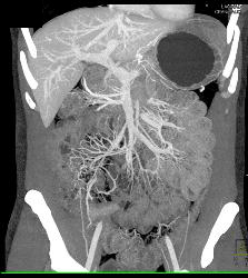 Active Crohn's Disease - CTisus CT Scan