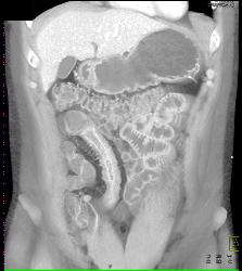 Active Crohn's Disease - CTisus CT Scan