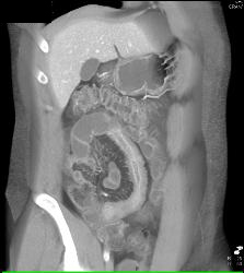 Active Crohn's Disease - CTisus CT Scan