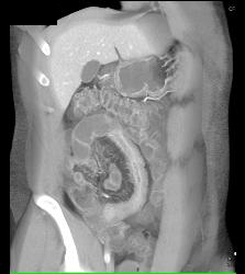 Active Crohn's Disease - CTisus CT Scan