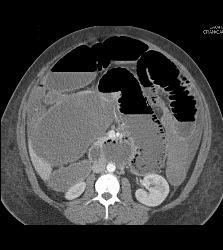 Small Bowel Obstruction (SBO) Due to Adhesions - CTisus CT Scan