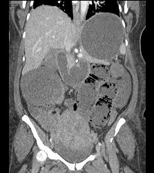 Small Bowel Obstruction (SBO) Due to Adhesions - CTisus CT Scan