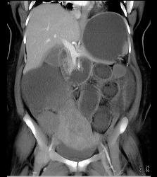 Small Bowel Obstruction (SBO) Due to Adhesions - CTisus CT Scan