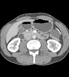 Mesenteric Cyst - CTisus CT Scan