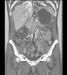 Mesenteric Cyst - CTisus CT Scan