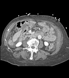 Midgut Volvulus With Ischemic Bowel- Non Enhancing - CTisus CT Scan