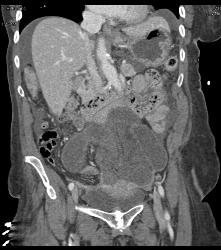 Midgut Volvulus With Ischemic Bowel- Non Enhancing - CTisus CT Scan