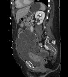 Midgut Volvulus With Ischemic Bowel- Non Enhancing - CTisus CT Scan