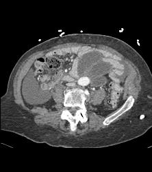 Midgut Volvulus With Ischemic Bowel- Non Enhancing - CTisus CT Scan