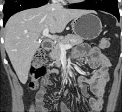 Clot in Superior Mesenteric Vein (SMV) Branch - CTisus CT Scan