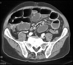 Ischemic Bowel - CTisus CT Scan