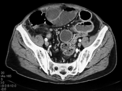 Ischemic Bowel - CTisus CT Scan