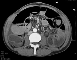 Ischemic Bowel - CTisus CT Scan