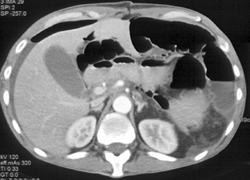 Ischemic Bowel - CTisus CT Scan