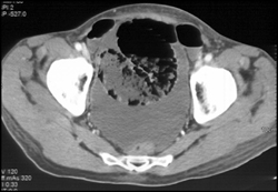 Ischemic Bowel - CTisus CT Scan