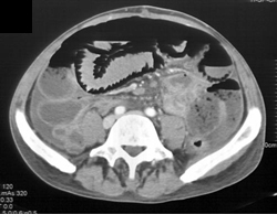 Pneumatosis With Ischemic Bowel - CTisus CT Scan