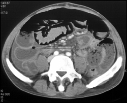 Pneumatosis With Ischemic Bowel - CTisus CT Scan