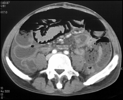 Pneumatosis With Ischemic Bowel - CTisus CT Scan