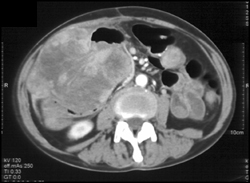 GIST Tumor Involving Small Bowel - CTisus CT Scan