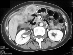 GIST Tumor Involving Small Bowel - CTisus CT Scan