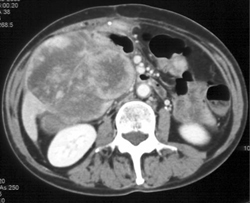 GIST Tumor Involving Small Bowel - CTisus CT Scan