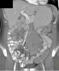 Lymphoma of Mesentery - CTisus CT Scan