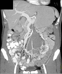 Lymphoma of Mesentery - CTisus CT Scan