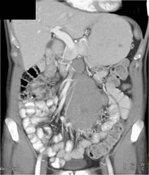 Lymphoma of Mesentery - CTisus CT Scan