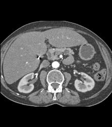 Duodenal Lipoma - CTisus CT Scan