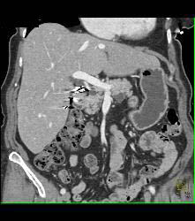 Duodenal Lipoma - CTisus CT Scan