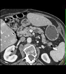 Intraductal Papillary Mucinous Neoplasm (IPMN) - CTisus CT Scan