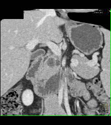 Superior Mesenteric Artery (SMA) Syndrome - CTisus CT Scan