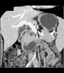 Superior Mesenteric Artery (SMA) Syndrome - CTisus CT Scan