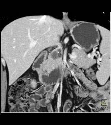 Superior Mesenteric Artery (SMA) Syndrome - CTisus CT Scan