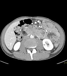 Duodenal Carcinoma With Multiple Renderings - CTisus CT Scan