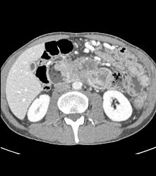 Duodenal Carcinoma With Multiple Renderings - CTisus CT Scan