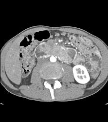 Duodenal Carcinoma With Multiple Renderings - CTisus CT Scan