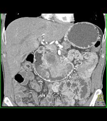 Duodenal Carcinoma With Multiple Renderings - CTisus CT Scan