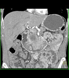 Duodenal Carcinoma With Multiple Renderings - CTisus CT Scan