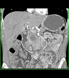 Duodenal Carcinoma With Multiple Renderings - CTisus CT Scan