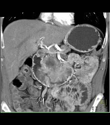 Duodenal Carcinoma With Multiple Renderings - CTisus CT Scan