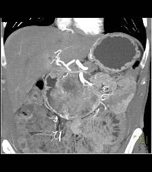 Duodenal Carcinoma With Multiple Renderings - CTisus CT Scan