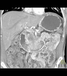 Duodenal Carcinoma With Multiple Renderings - CTisus CT Scan