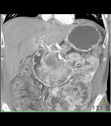 Duodenal Carcinoma With Multiple Renderings - CTisus CT Scan