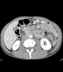 Duodenal Carcinoma With Multiple Renderings - CTisus CT Scan