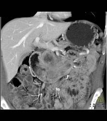 Duodenal Carcinoma With Multiple Renderings - CTisus CT Scan