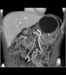 Duodenal Carcinoma With Multiple Renderings - CTisus CT Scan